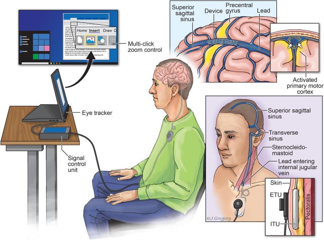Việc kết nối máy tính và não người giúp bệnh nhân có tiến triển trong bệnh tình